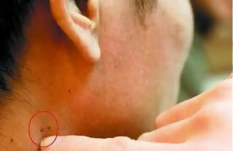 不要错把艾滋病当皮肤病,皮肤出现3种情况,可能是艾滋发信号