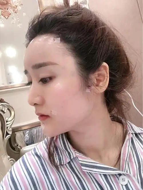 自体全脸脂肪填充第一天