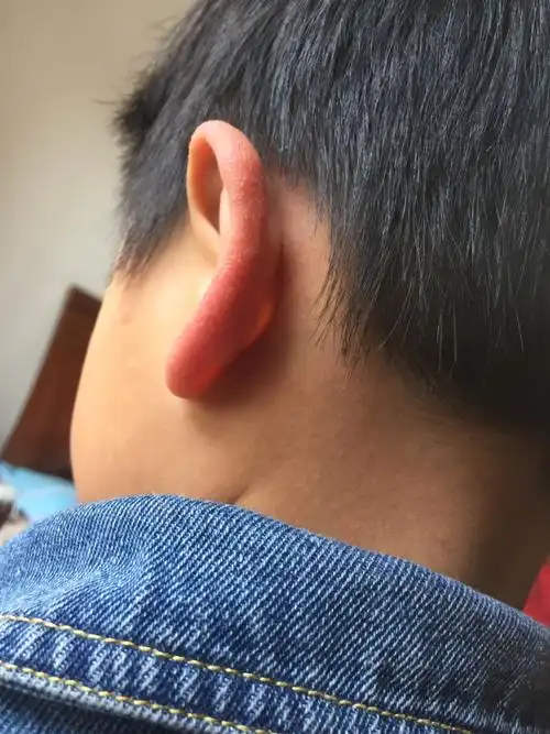 孩子耳朵上长了好多像鸡皮疙瘩一样的东西,耳朵很烫