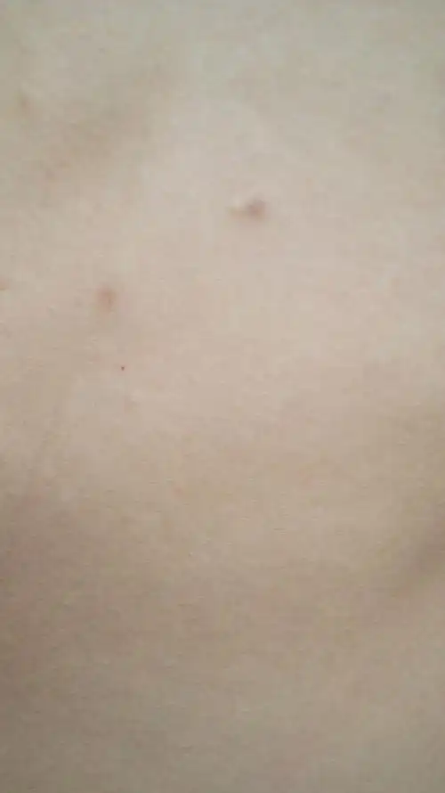 为什么我胸部有一点点的肉色痘痘,是什么东西?求解答