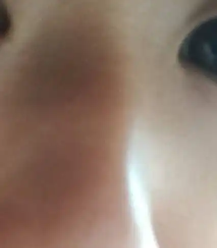 鼻子鼻骨为什么是黑色的