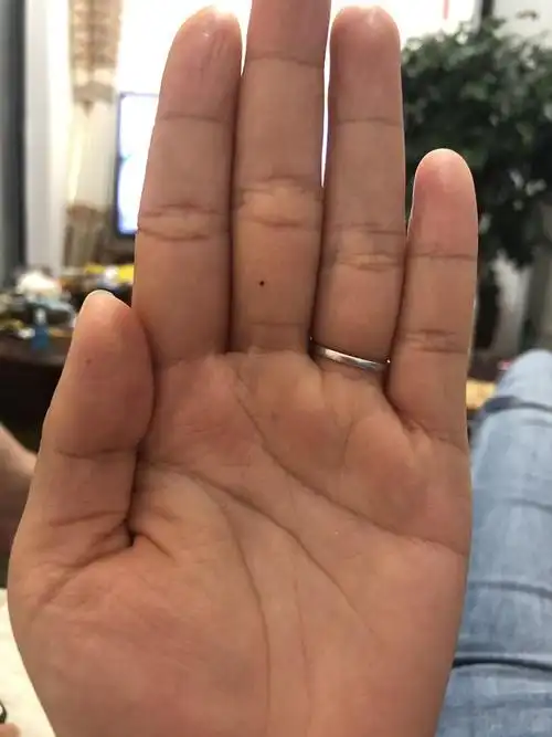 无伤大雅不想要也可以去掉 用米之华 不会留痣坑的女人左手中指有