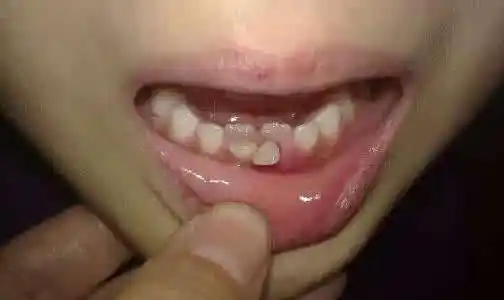 乳牙还没"下岗",恒牙却长歪了近日,六岁的豆豆告诉妈妈,自己吃东西时