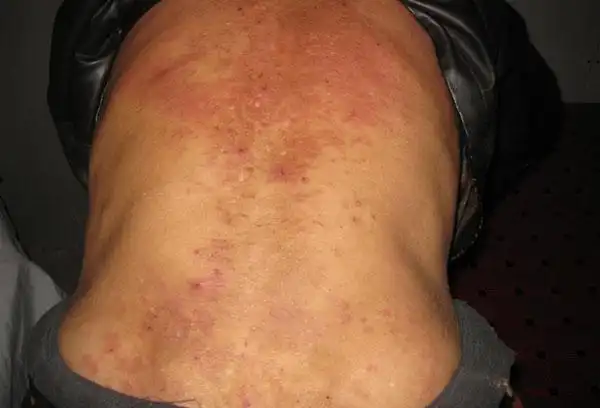 如何区分湿疹和艾滋病从三方面入手