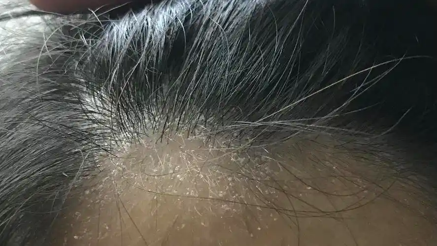 有人和我一样到冬天头皮就干吗怎么办啊