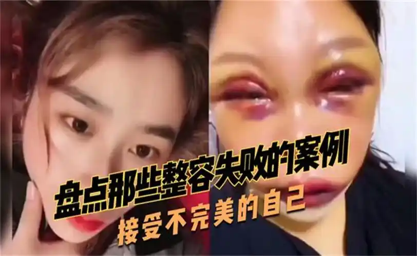 盘点那些整容失败的案例,身体发肤,受之父母,接受不完美的自己