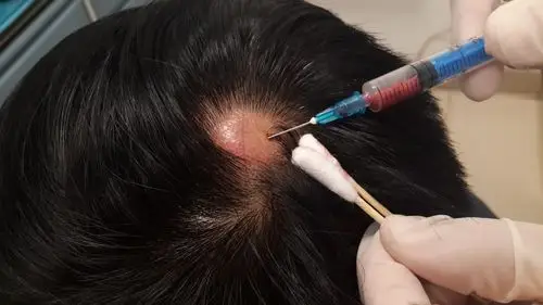 3. 皮损内注射德宝松,促进炎症的消退.