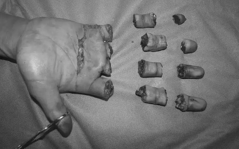 这也造就了手外科的"黄金年代",断肢再植,断指再植这些"奇迹"般的手术