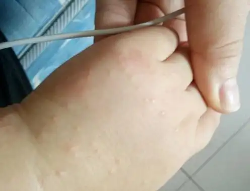 宝宝长疥疮怎么办