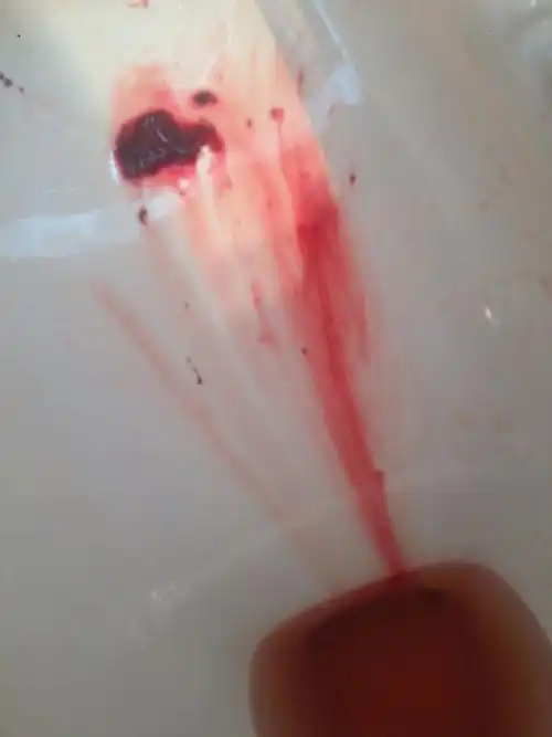 每个月都按时正常来了大姨妈!什么会有血快?是不是有身体有有问题?