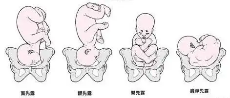 这是一种胎儿头位的种类,是宝宝的面部朝下.如图所示(第一种)