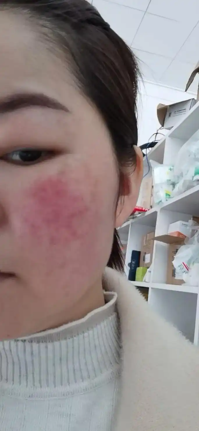 图片是本人!因为年轻时候乱用护肤品,化妆导致皮肤反复过敏,后 - 抖音