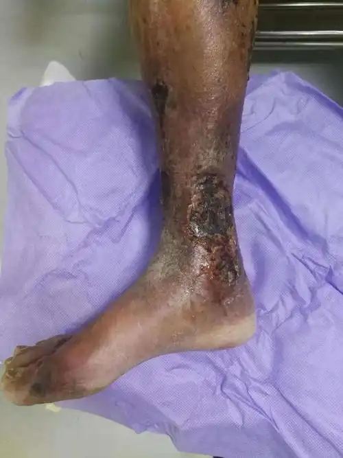 下肢皮肤坏死感染～慢创