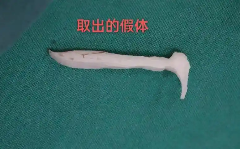 做鼻修复时从鼻子里取出的一些怪异的假体,大家可以感受一下!