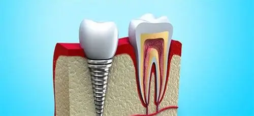 这8条种植牙的利与弊帮你抉择更适合镶牙还是种牙