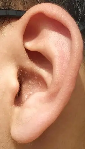 耳朵里痒里面的皮肤感觉和耳屎一样特别多怎么回事是皮肤病么