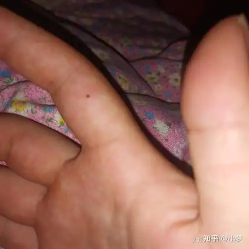 女生右手中指突然长了个小痣代表什麼