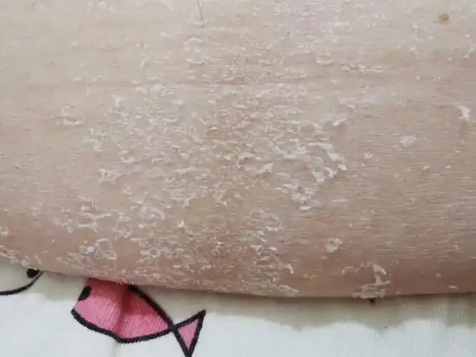 冬季皮肤干燥案例及护理要点分享_皮肤病_皮肤病相关疾病 - 好大夫