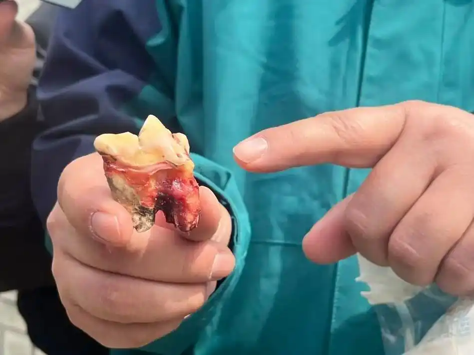 4月24日,工作人员为记者展示拔掉的虎牙.新华社记者 赵丹丹 摄