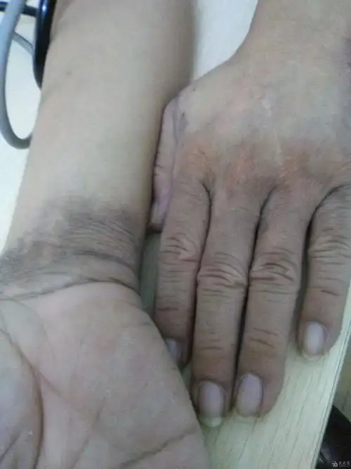 手足皮肤黑变