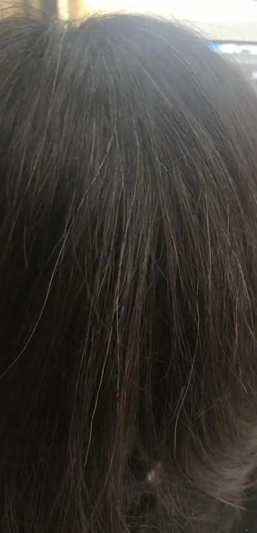 后脑勺突然长了很多白头发03