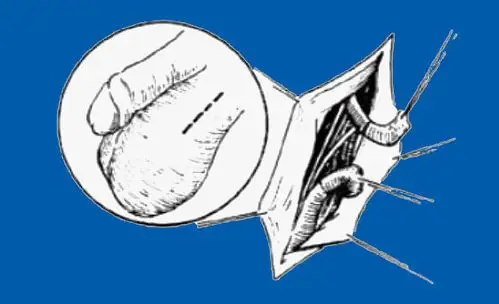 喜悦男的睾丸穿刺的危害"科头跣足"-第1张图片-追风博客