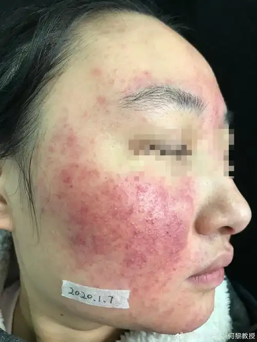 病例分享##走进何阿姨の临床生活#【皮肤屏障的天然保护因子 上】