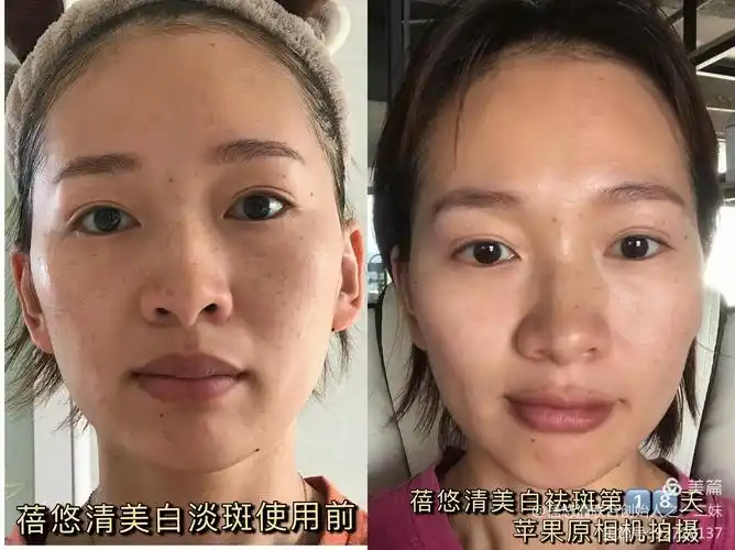 最简单有效祛斑的土方法_民间祛斑小秘方,民间祛斑偏