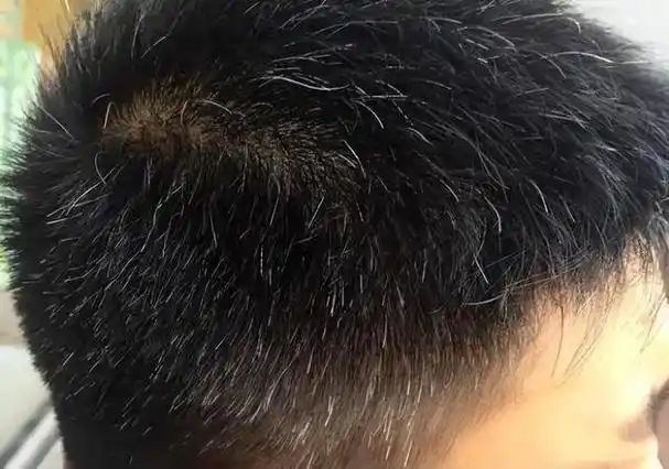 白头发的原因找到了,少白头,中白头,老白头的治法在此