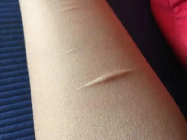 想知道我是不是疤痕体质?请大神帮忙