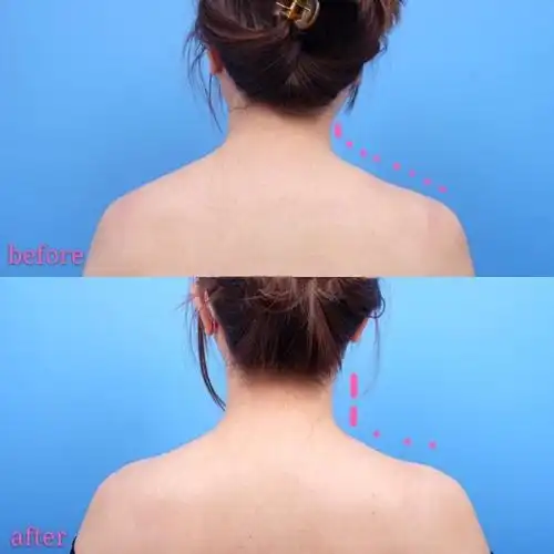 我的肩膀术前斜方肌大且背很厚,打了瘦肩针之后最明显_圈子-新氧美容