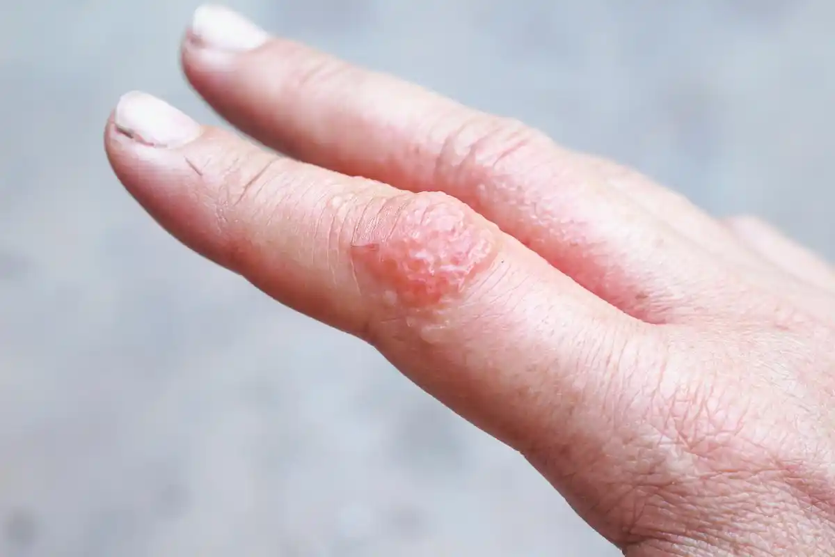 过敏性皮炎,又称为湿疹,是一种常见的皮肤病.