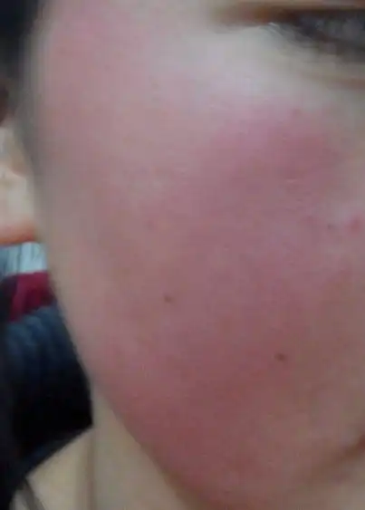 第一次过敏 吃药 一个月过后好了 没过两三星期又过敏了 面部红血丝