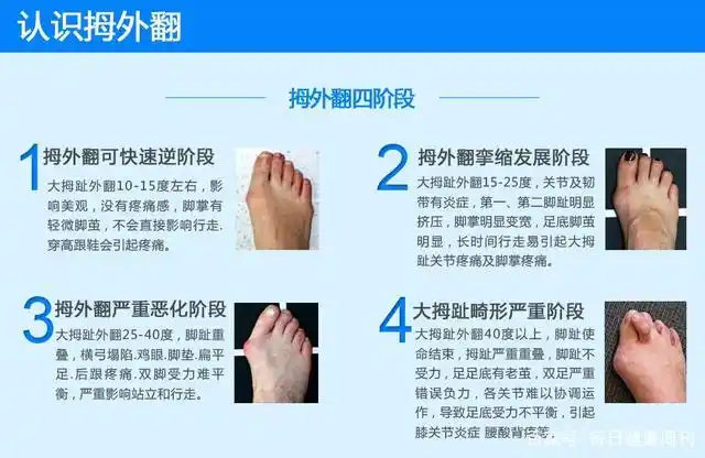 上海健桥医院拇外翻侯明主任:拇外翻会越来越严重么