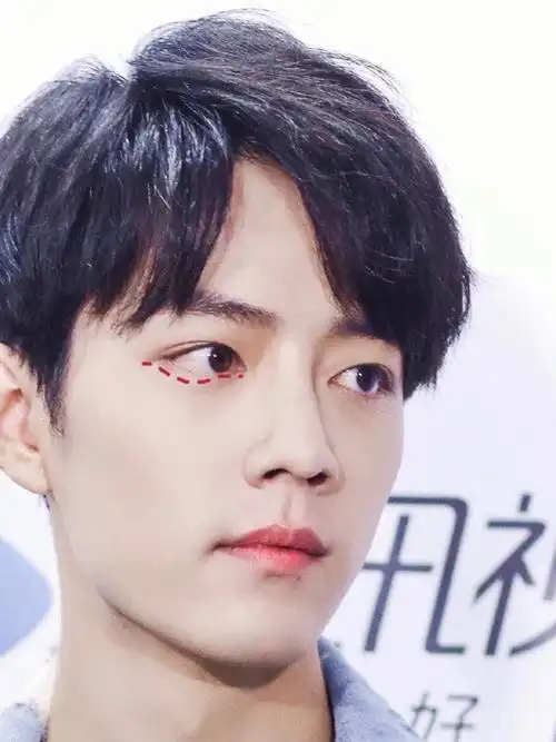 7915肖战有没有做下眼下至术,我觉得是有的.