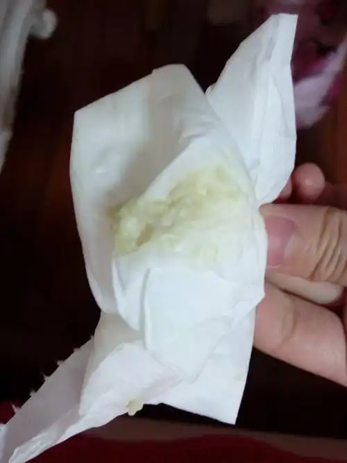 检查了两次白带常规,第一次查出霉菌,清洁度3,用了药以后复查变成细菌