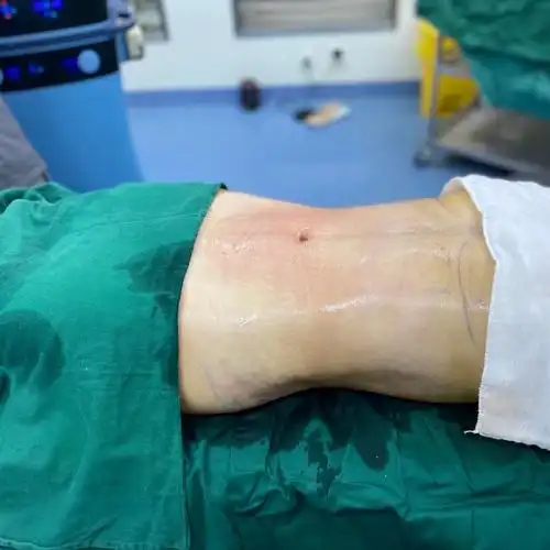 【人鱼体雕腰腹环吸塑形】