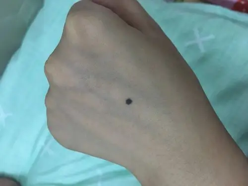 女,请问左手掌背有黑痣,右手金星丘有红痣是代表什么呢?