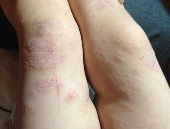 女性湿疹症状图片 (3)_有来医生