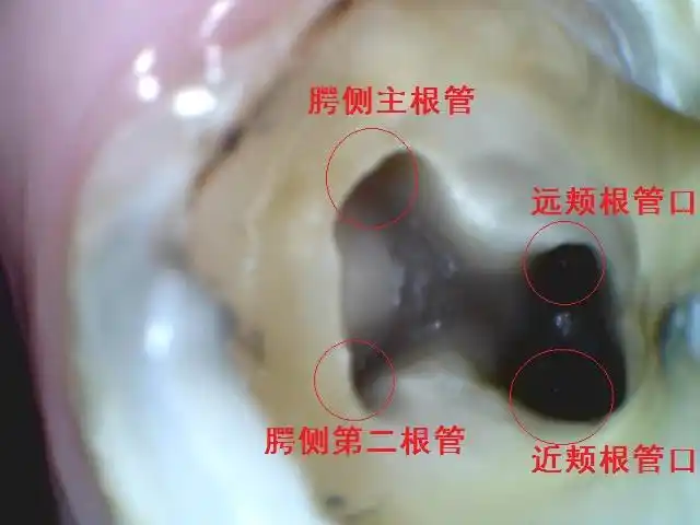 罕见的上颌第二磨牙腭侧双根管病例展示