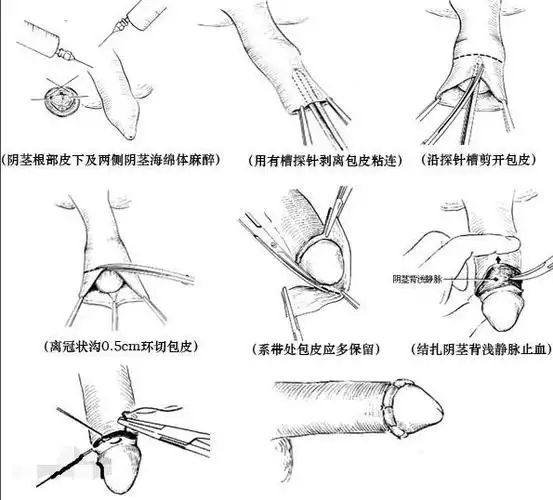 包皮手术后伤口愈合图片详解