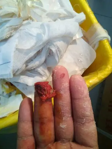 右手无名指手指盖处全部掉了,大概有一工分多点吧!