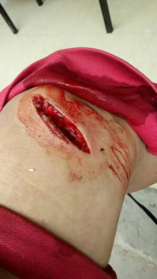 我在广西武宣砍桉树,脚被油锯锯伤,老板工资没付