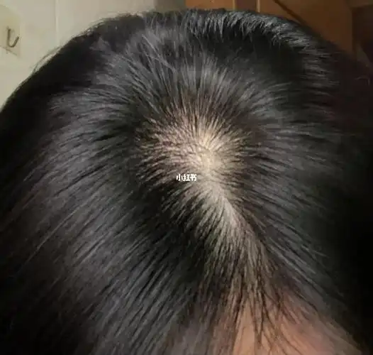 掉头发油性发质 脂溢性脱发