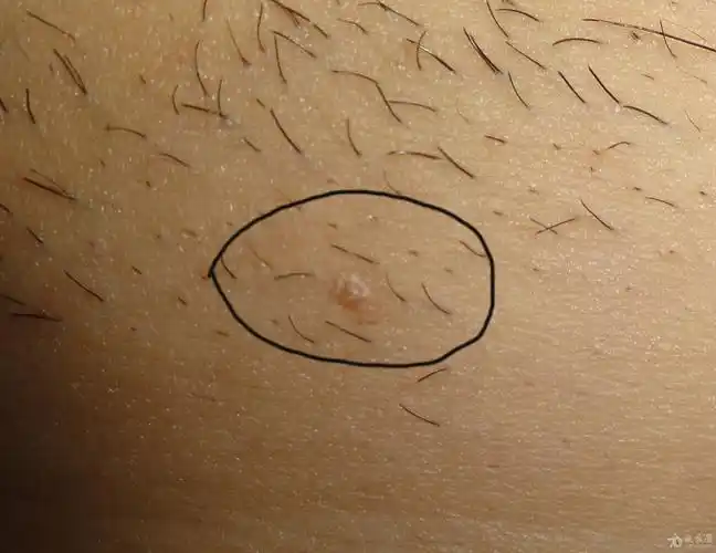 不好意思想麻烦大家再帮我看一下这两处是不是新的尖锐湿疣疣体?