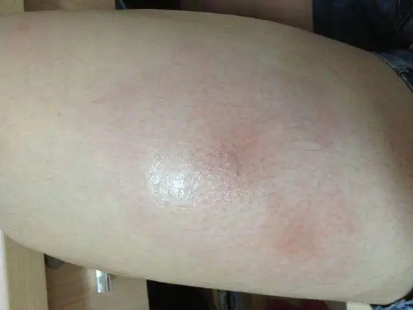 以前蚊子叮没起这么大的包的话,那就一