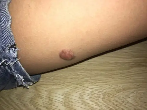 十二岁的小孩大腿根上长了一个粉瘤要切除的话会不会有什么后遗症,要