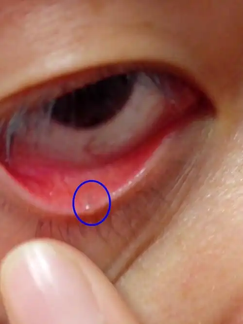 眼睑里张了一条黑线,不知道里面长了什么,平时能感觉得到但是不痛