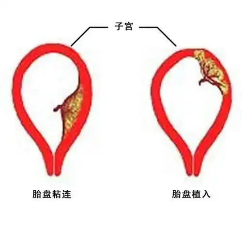 左上图为胎盘粘连,胎盘植入示意图, 剥离过程中产妇出现大出血,楞毅