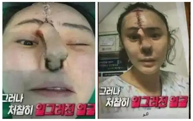 少女隆鼻致死网红削骨被割大动脉整容的代价也太可怕了
